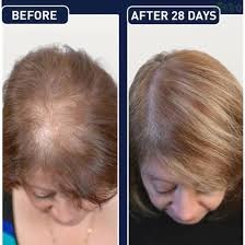 FEG Hair Growth Spray | Buy One Get One Free | Original Imported